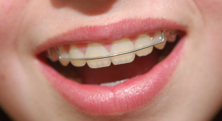 Invisalign Retainers Custom Made Vivera Invisalign Retainers