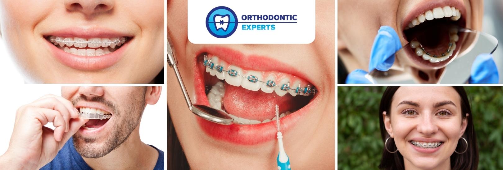 10 FREQUENTLY ASKED QUESTIONS ON INVISIBLE ORTHODONTICS