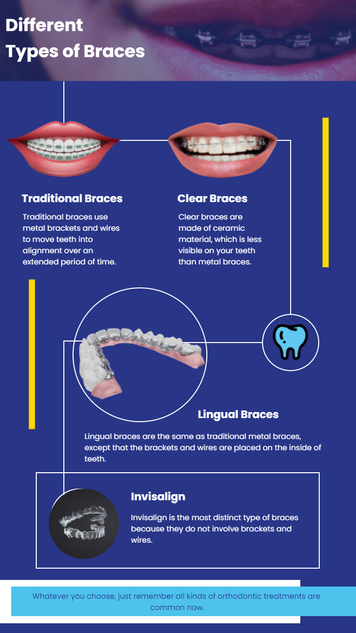 Different Types of Braces | Different kinds of Braces