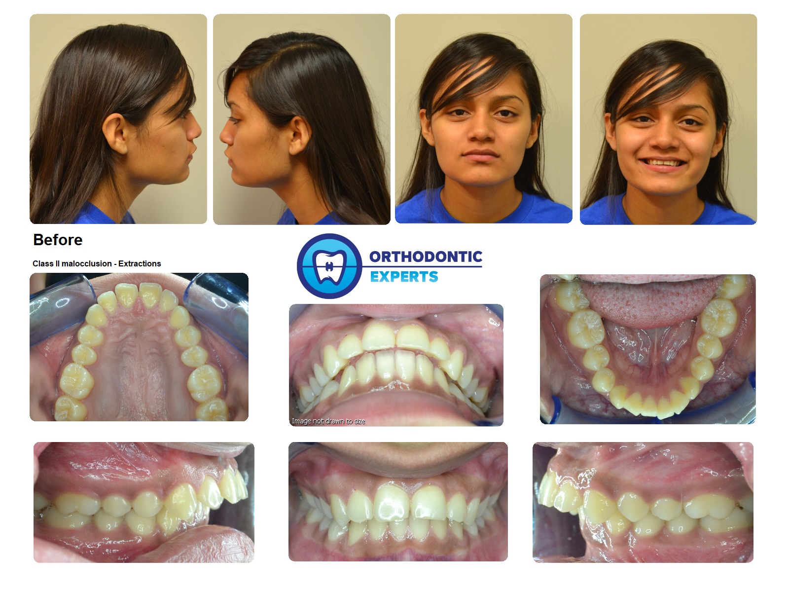 1.Extractions Top Orthodontist Braces, Invisalign