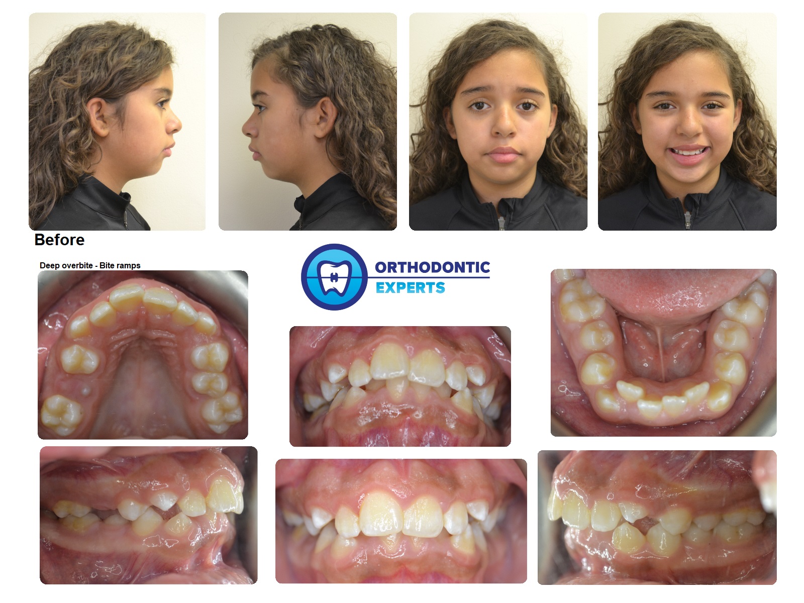 Ramps On Braces at Arthur Conroy blog