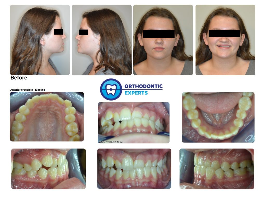 2.Elastics | Top Orthodontist: Braces, Invisalign