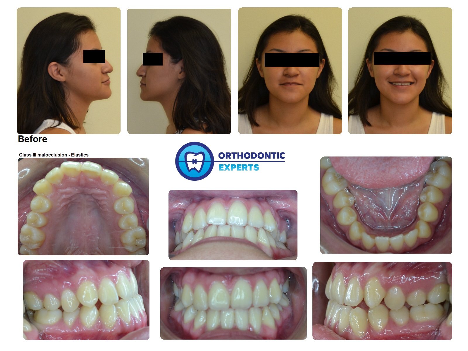 5.Elastics | Top Orthodontist: Braces, Invisalign