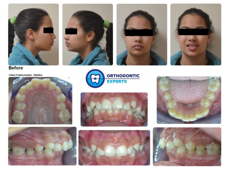 5.Elastics Top Orthodontist Braces, Invisalign