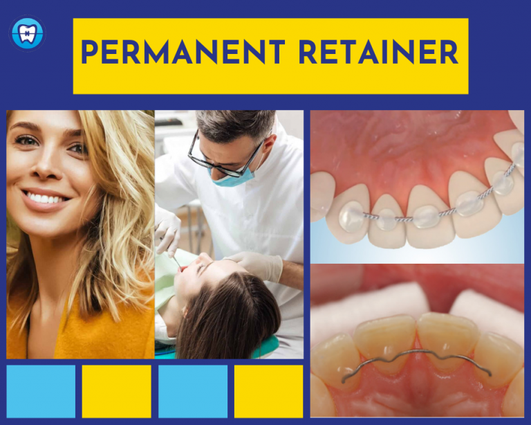 A Permanent Retainer For Permanent Smile | Pros, Cons And Cost