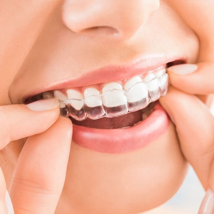 Get Invisalign Treatment from Exerts Orthodontists