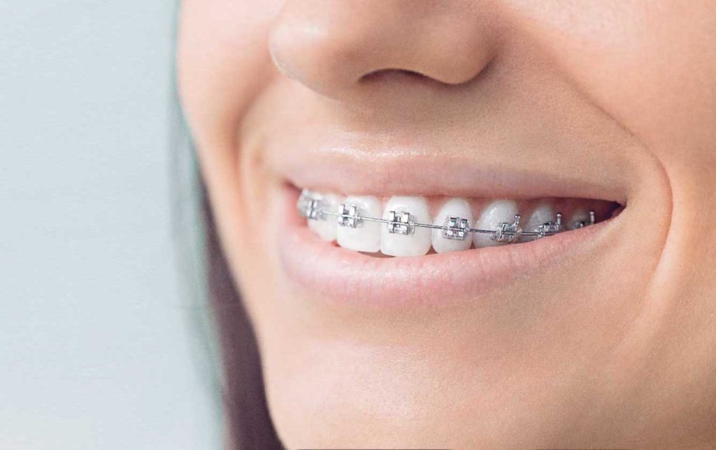Do Braces And Invisalign Change Your Face Shape
