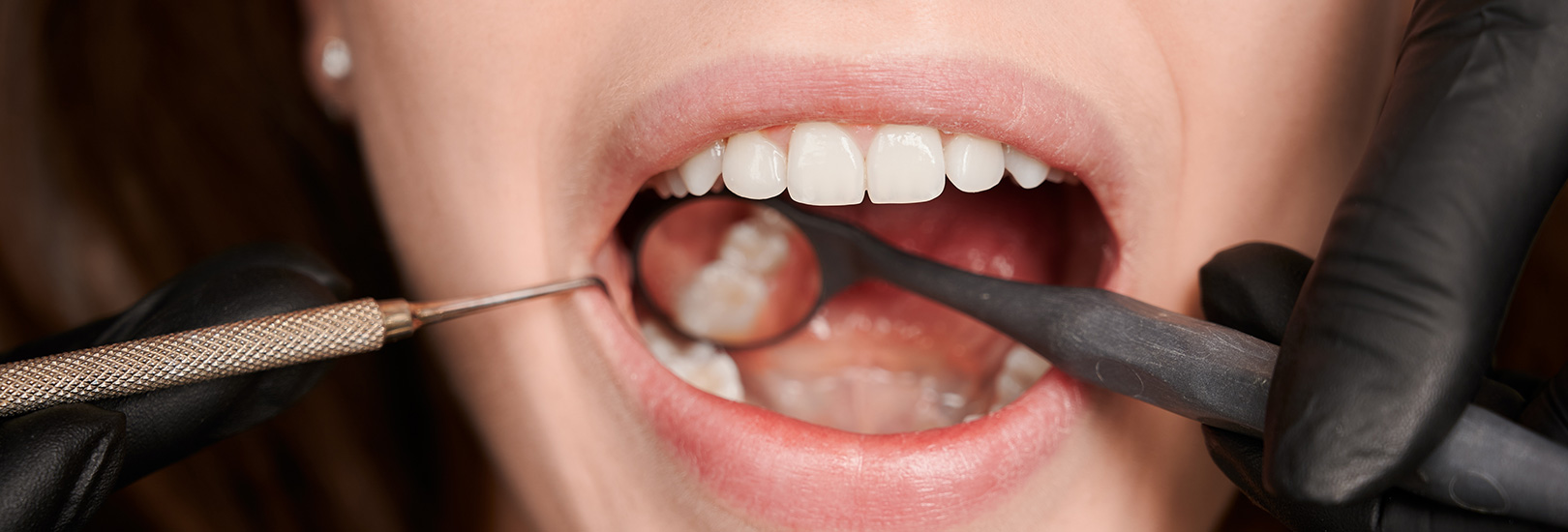 Using Spacers for Braces: What You Need to Know