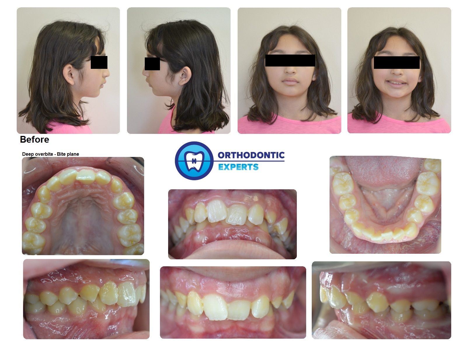 Braces Elastics (Rubber Bands) for Bite Correction and Alignment