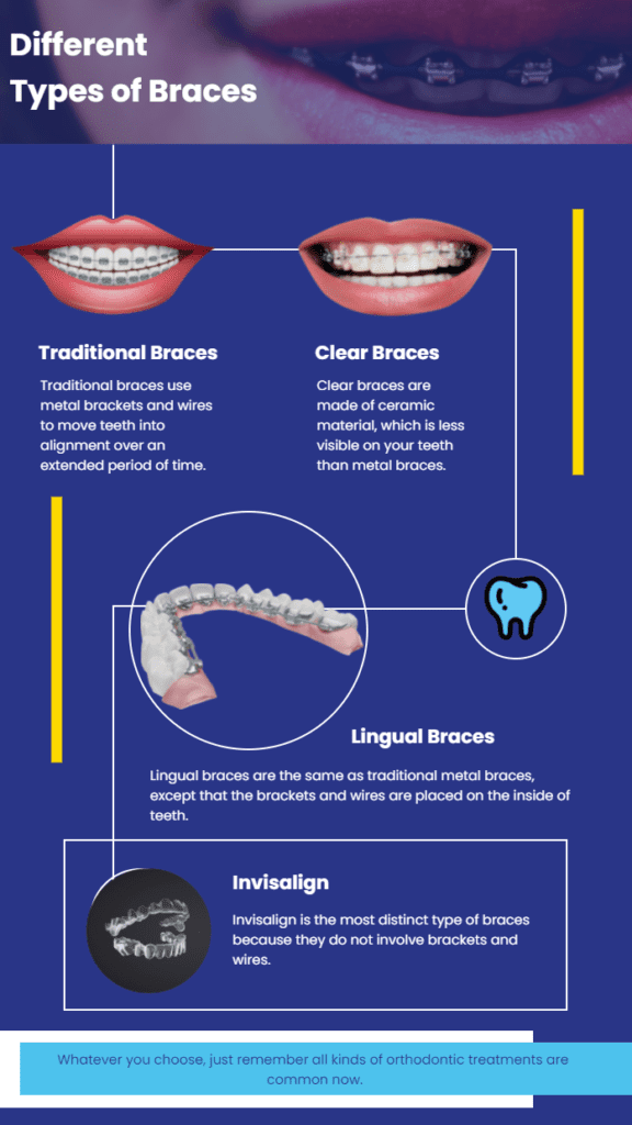 Different Types of Braces  Different kinds of Braces